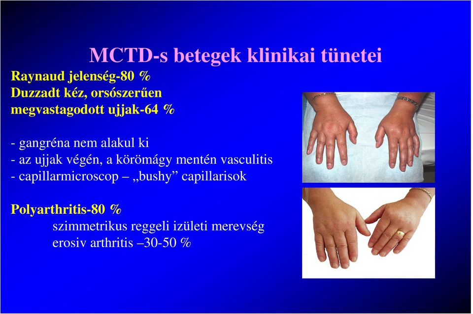 végén, a körömágy mentén vasculitis - capillarmicroscop bushy capillarisok