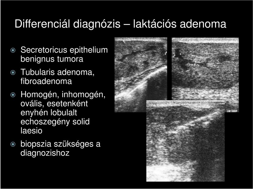 fibroadenoma Homogén, inhomogén, ovális, esetenként