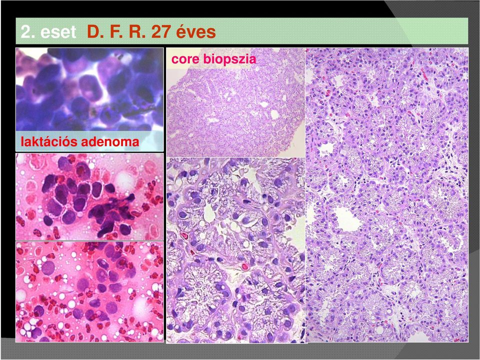 core biopszia