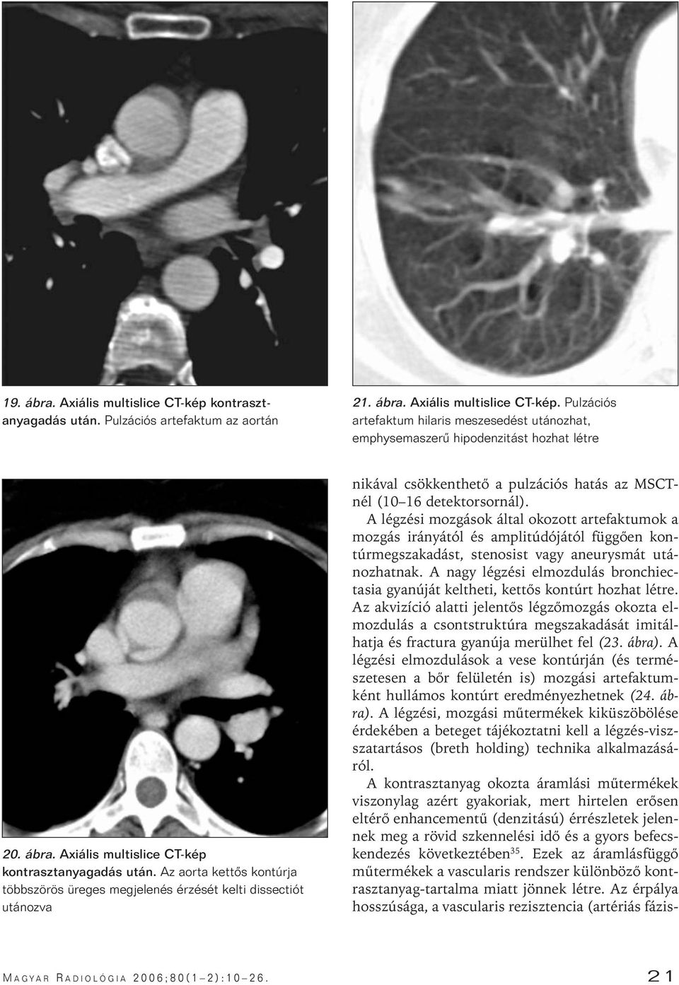 Az aorta kettôs kontúrja többszörös üreges megjelenés érzését kelti dissectiót utánozva nikával csökkenthetô a pulzációs hatás az MSCTnél (10 16 detektorsornál).