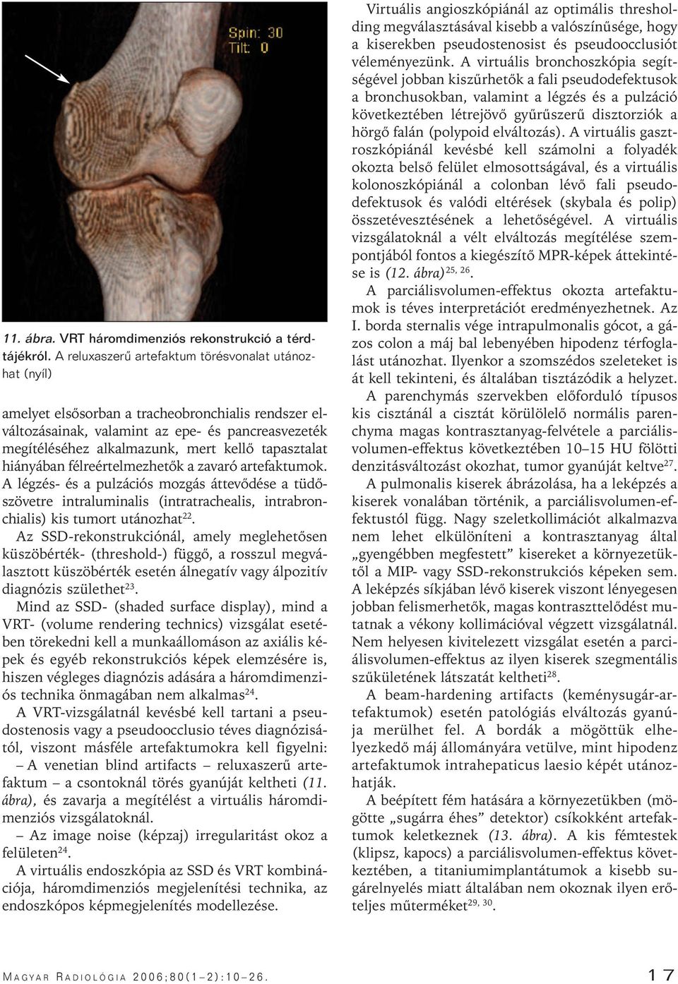 tapasztalat hiányában félreértelmezhetôk a zavaró artefaktumok. A légzés- és a pulzációs mozgás áttevôdése a tüdôszövetre intraluminalis (intratrachealis, intrabronchialis) kis tumort utánozhat 22.
