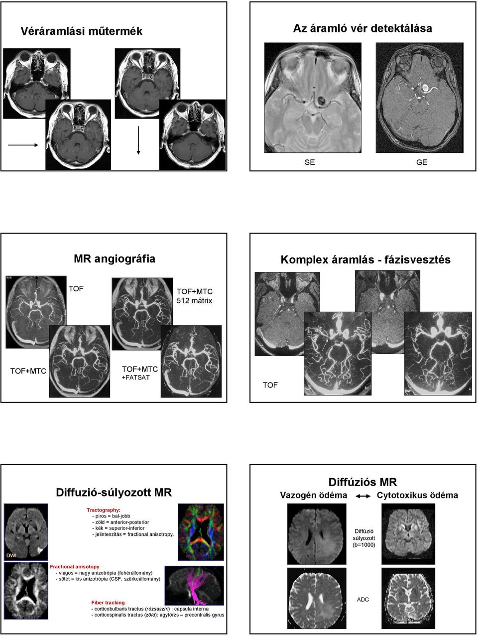 Diffúziós MR Vazogén ödéma Cytotoxikus ödéma Diffúzió súlyozott (b=1000) DWI Fractional anisotopy: - viágos = nagy anizotrópia (fehérállomány) - sötét = kis