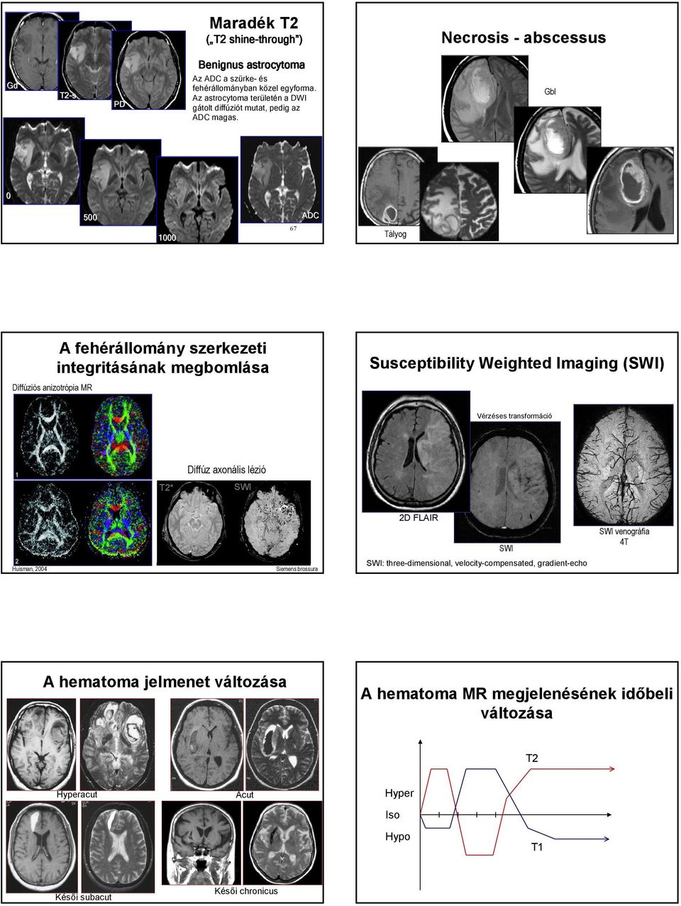 Gbl 0 500 1000 67 ADC Tályog Diffúziós anizotrópia MR A fehérállomány szerkezeti integritásának megbomlása Susceptibility Weighted Imaging (SWI) Vérzéses transformáció