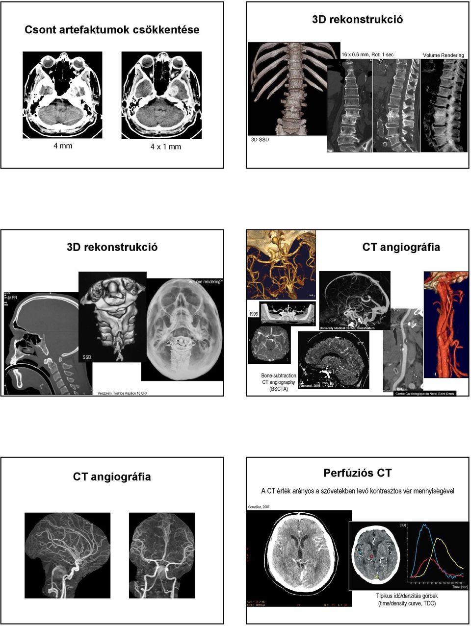 Center, Center, Grosshadern SSD Veszprém, Toshiba Aquilion 16 CFX Bone-subtraction CT angiography (BSCTA) Tomandl, Tomandl, 2006