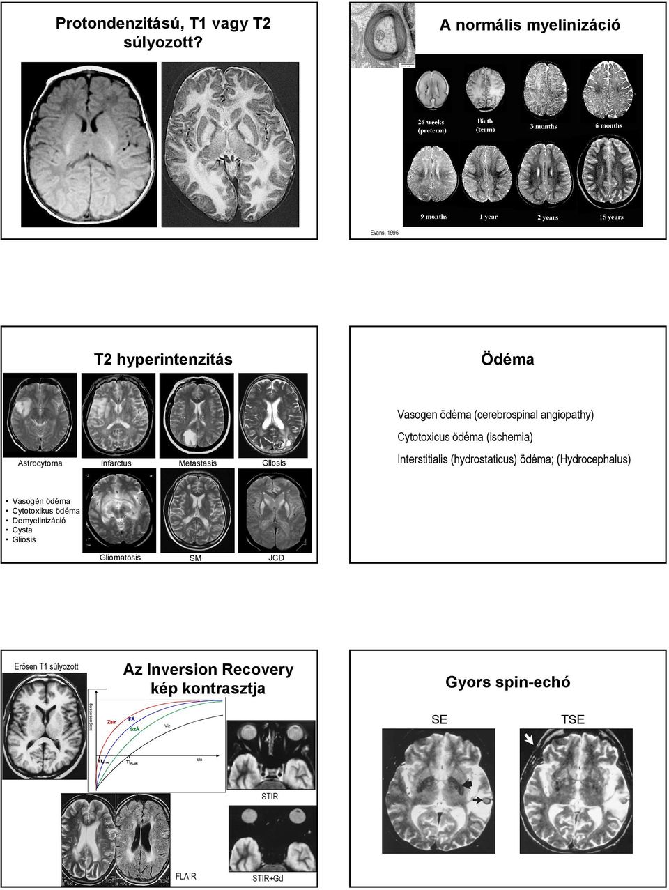 ödéma (ischemia) Astrocytoma Gliosis Interstitialis (hydrostaticus) ödéma; (Hydrocephalus) Vasogén ödéma