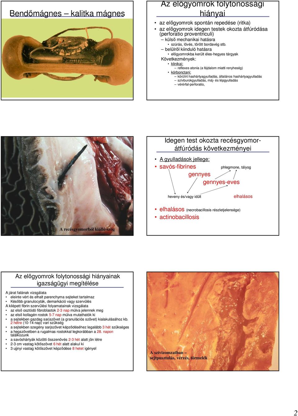 belülrıl kiinduló hatásra elıgyomrokba került éles-hegyes tárgyak Következmények: klinikai: reflexes atonia (a fájdalom miatti renyheség) kórbonctani: körülírt hashártyagyulladás, általános