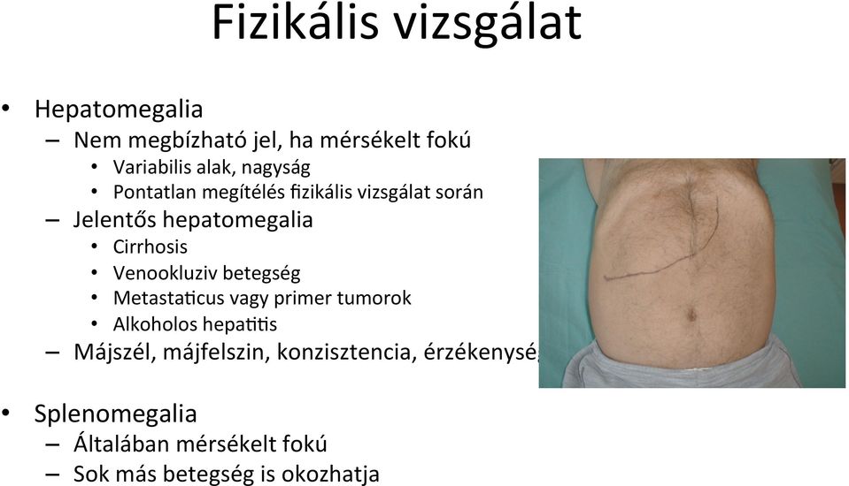 Venookluziv betegség MetastaAcus vagy primer tumorok Alkoholos hepaaas Májszél,