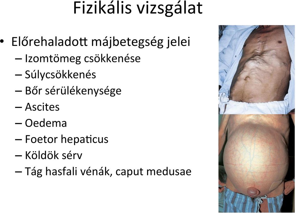 sérülékenysége Ascites Oedema Foetor