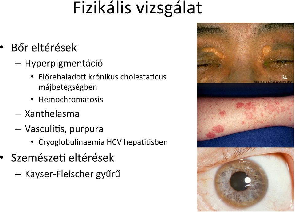 Hemochromatosis Xanthelasma VasculiAs, purpura