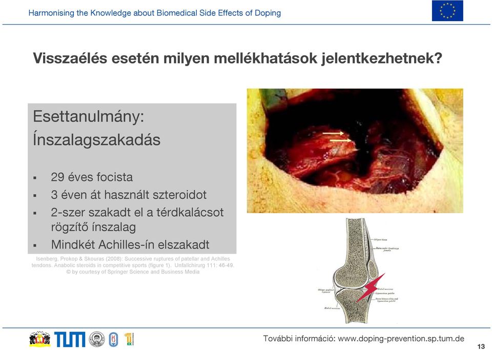 térdkalácsot rögzítő ínszalag Mindkét Achilles-ín elszakadt Isenberg, Prokop & Skouras (2008): Successive