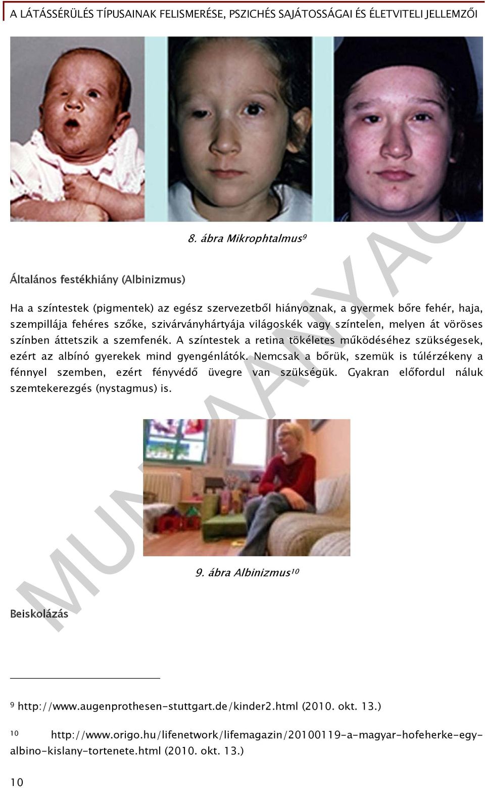 melyen át vöröses színben áttetszik a szemfenék. A színtestek a retina tökéletes működéséhez szükségesek, ezért az albínó gyerekek mind gyengénlátók.