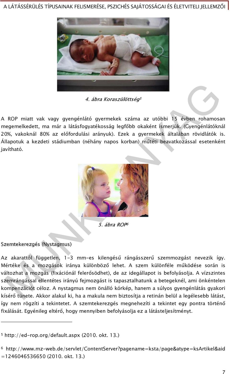 Szemtekerezgés (Nystagmus) 5. ábra ROP 6 Az akarattól független, 1-3 mm-es kilengésű rángásszerű szemmozgást nevezik így. Mértéke és a mozgások iránya különböző lehet.