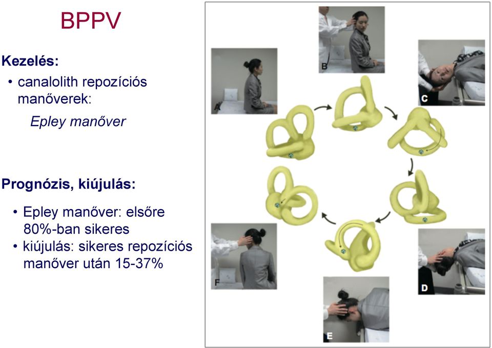 kiújulás: Epley manőver: elsőre 80%-ban
