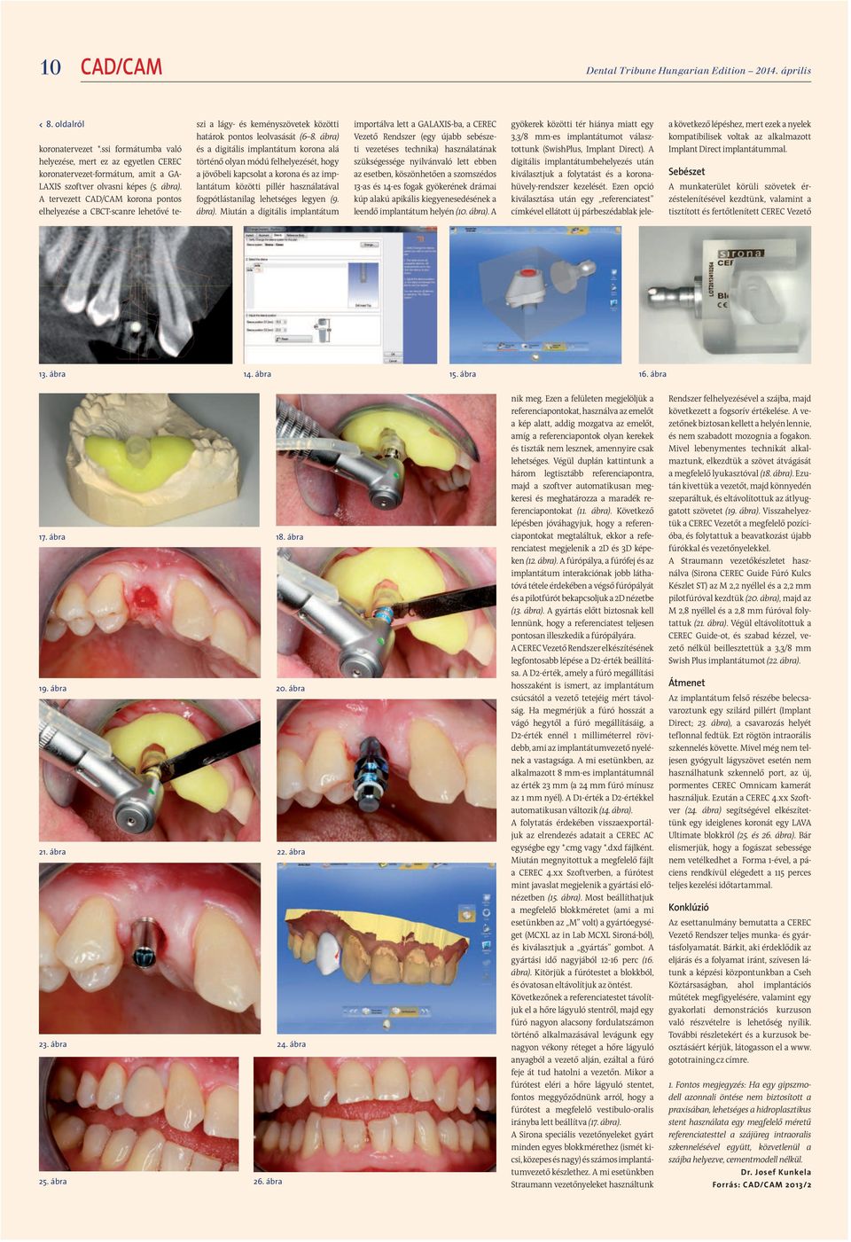 A tervezett CAD/CAM korona pontos elhelyezése a CBCT-scanre lehetővé teszi a lágy- és keményszövetek közötti határok pontos leolvasását (6 8.