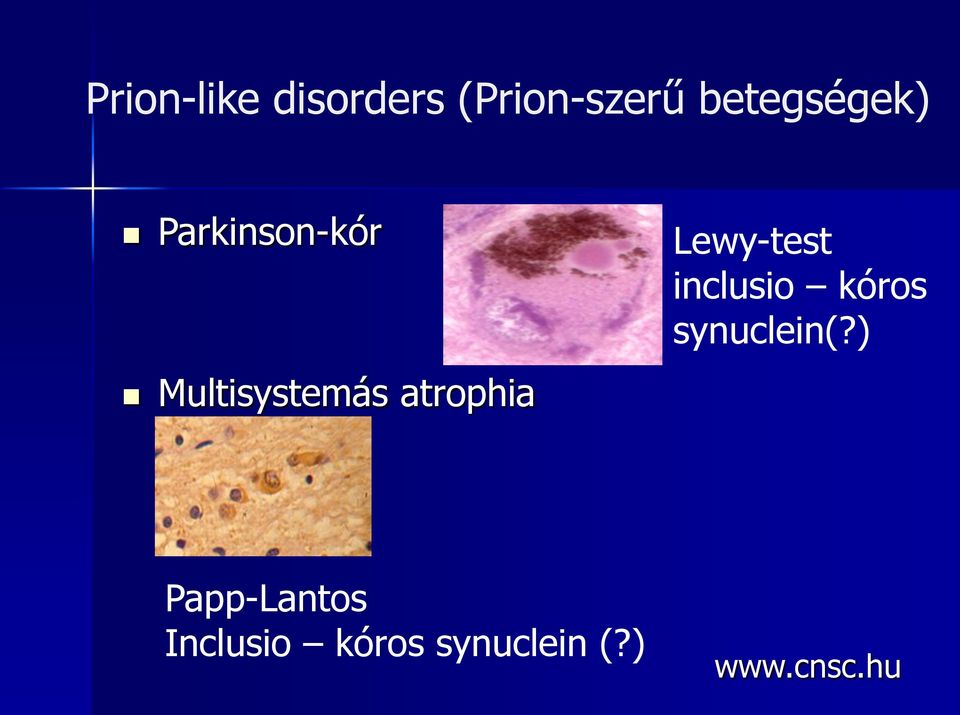 atrophia Lewy-test inclusio kóros