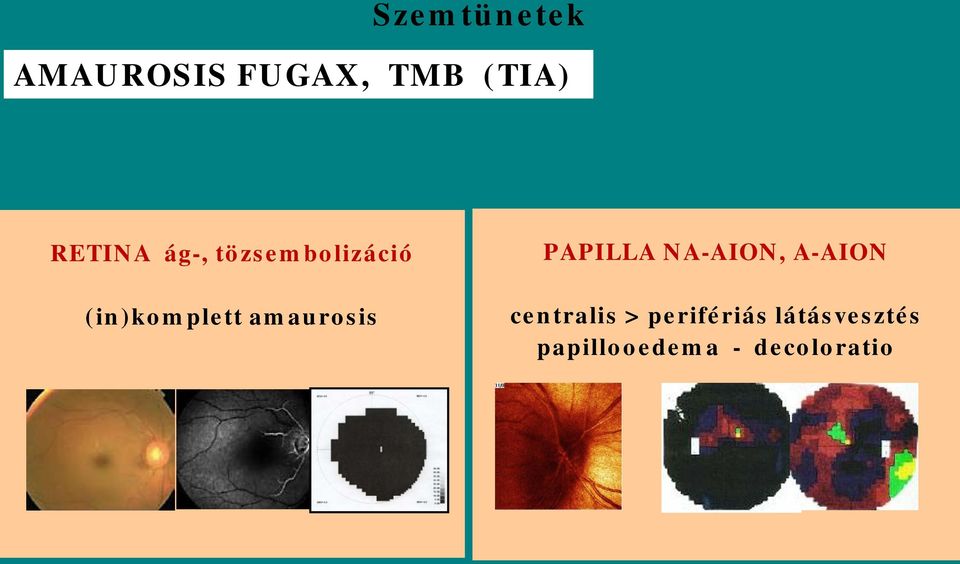 amaurosis PAPILLA NA-AION, A-AION centralis