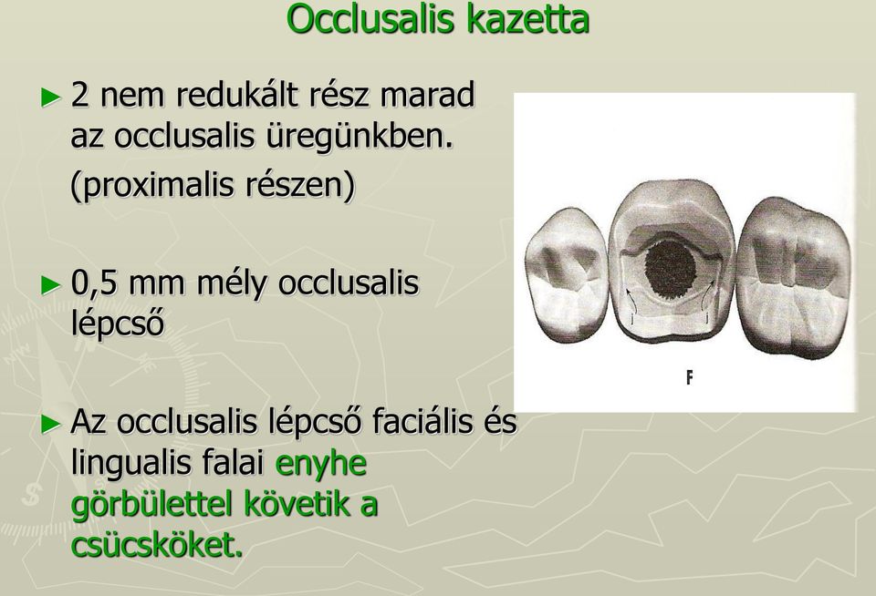 (proximalis részen) 0,5 mm mély occlusalis lépcső Az