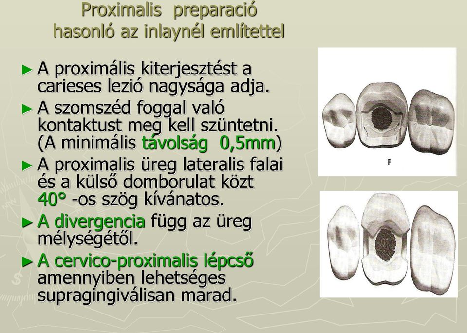 (A minimális távolság 0,5mm) A proximalis üreg lateralis falai és a külső domborulat közt 40 -os