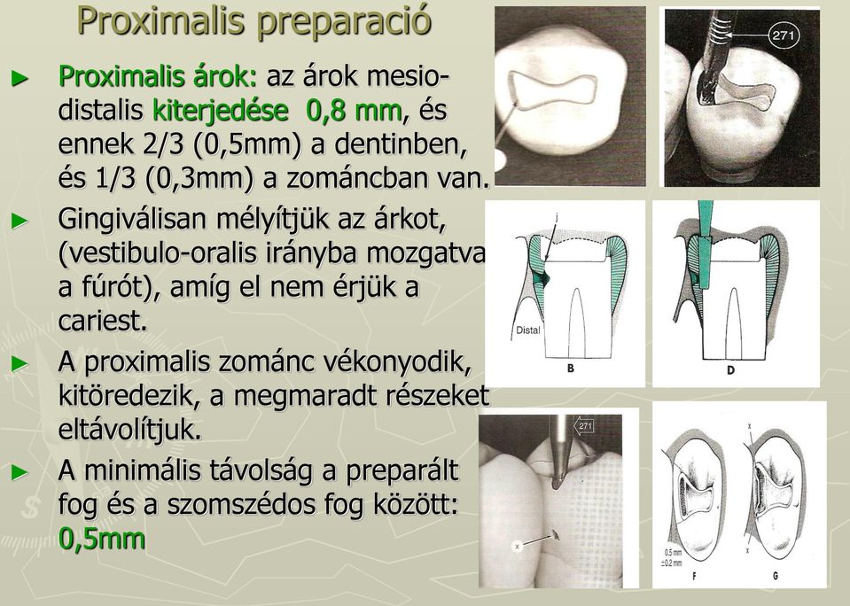 Gingiválisan mélyítjük az árkot, (vestibulo-oralis irányba mozgatva a fúrót), amíg el nem érjük a