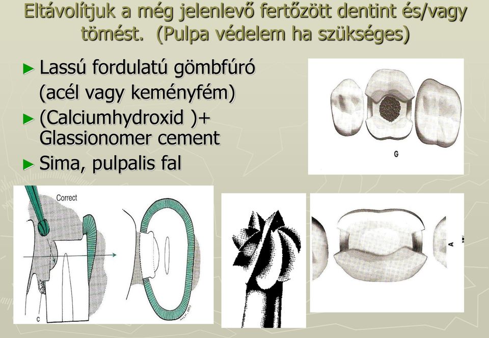 (Pulpa védelem ha szükséges) Lassú fordulatú