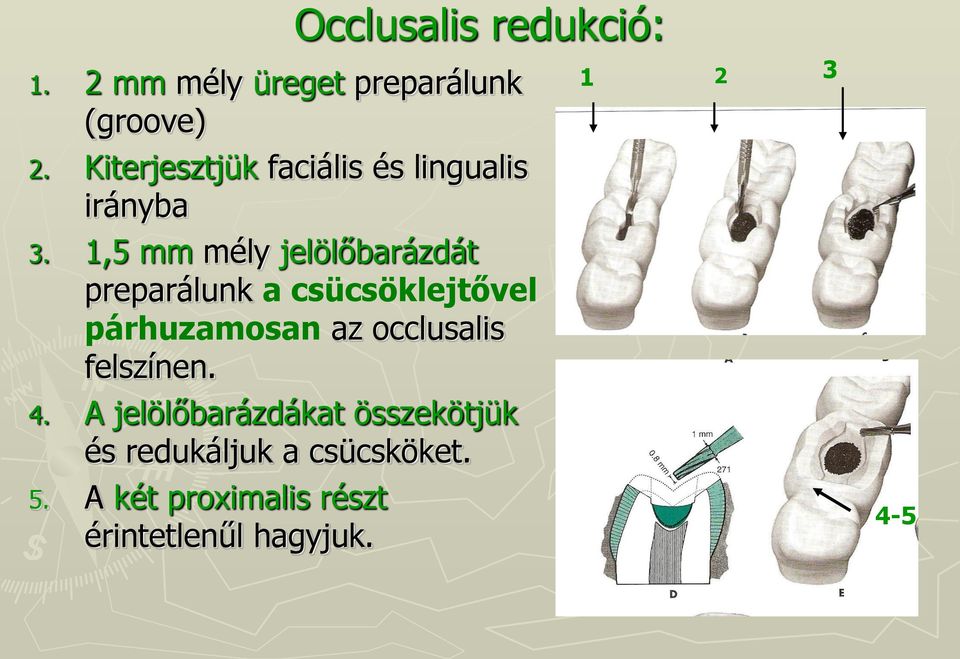 1,5 mm mély jelölőbarázdát preparálunk a csücsöklejtővel párhuzamosan az