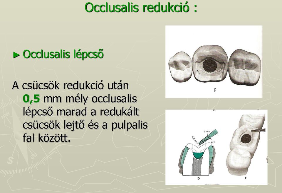 mély occlusalis lépcső marad a