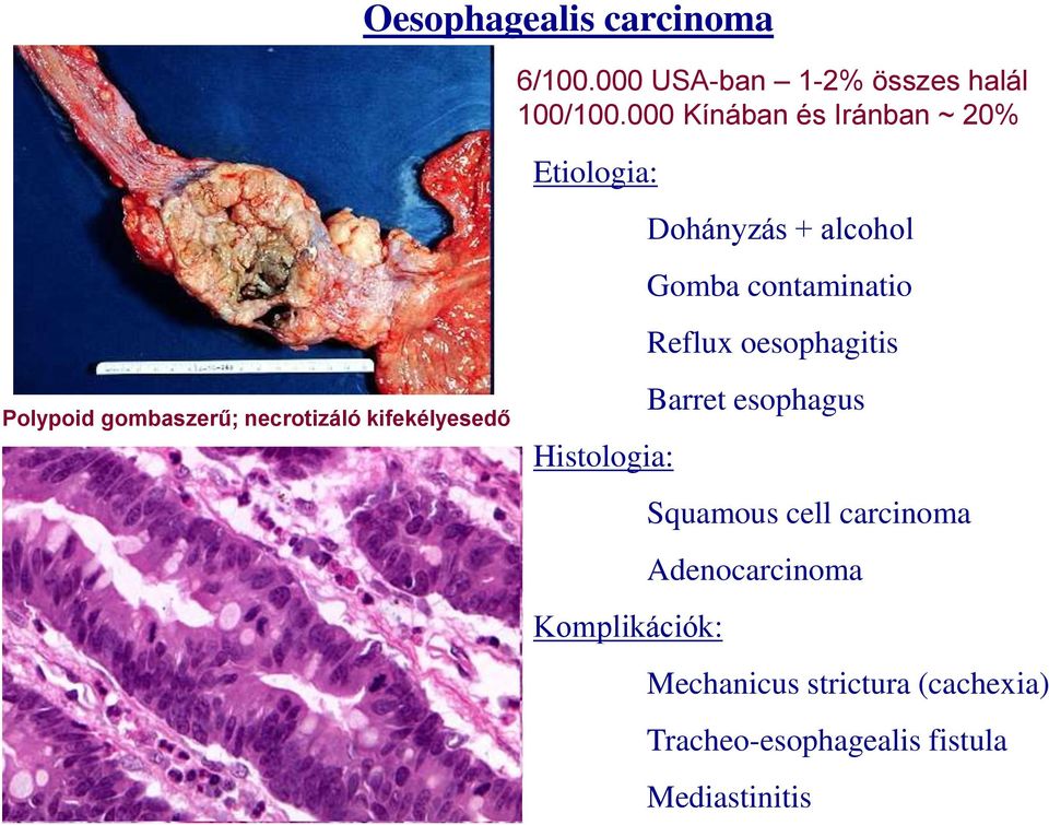 oesophagitis Polypoid gombaszerű; necrotizáló kifekélyesedő Barret esophagus Histologia: