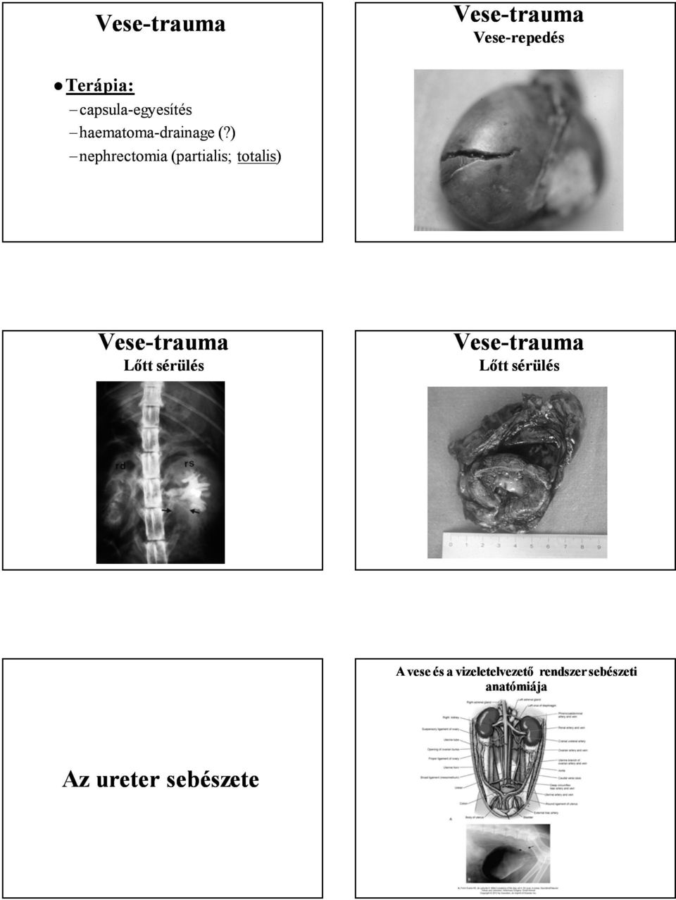 ) nephrectomia (partialis; totalis) Lőtt