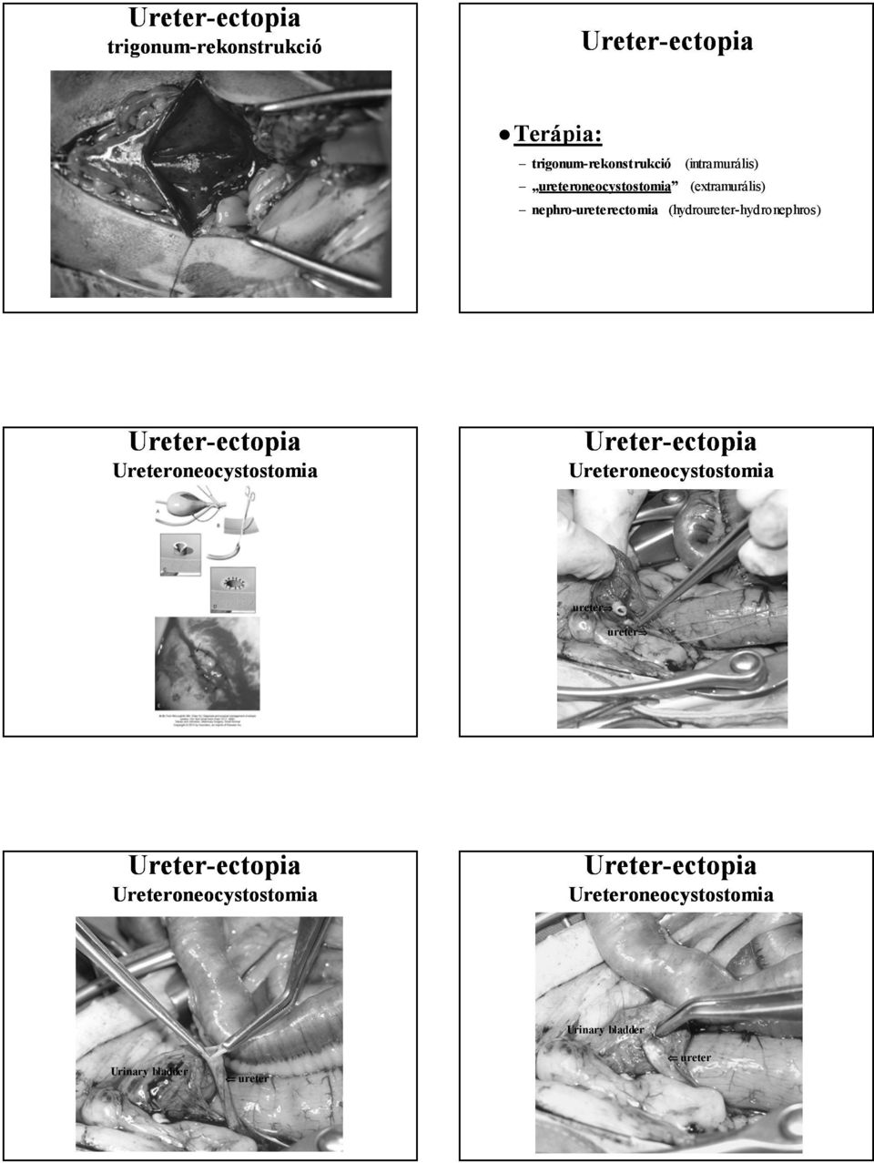 (hydroureter-hydronephros) Ureter- Ureteroneocystostomia Ureter- Ureteroneocystostomia