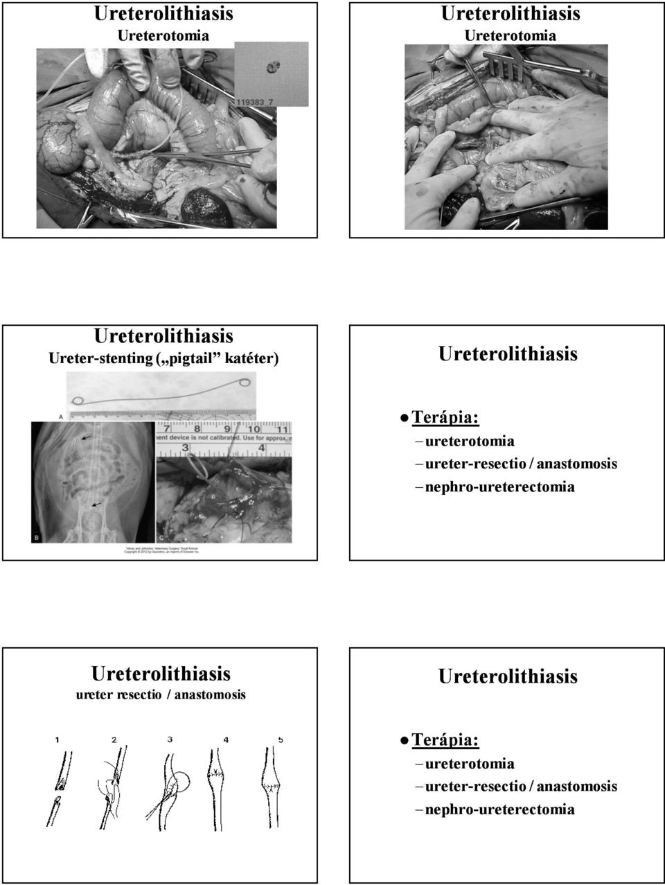 nephro-ureterectomia ureter resectio / anastomosis