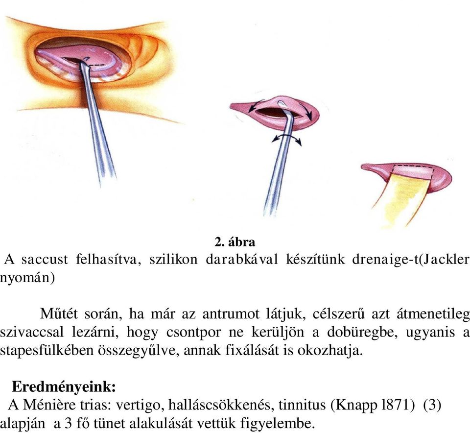 dobüregbe, ugyanis a stapesfülkében összegyűlve, annak fixálását is okozhatja.