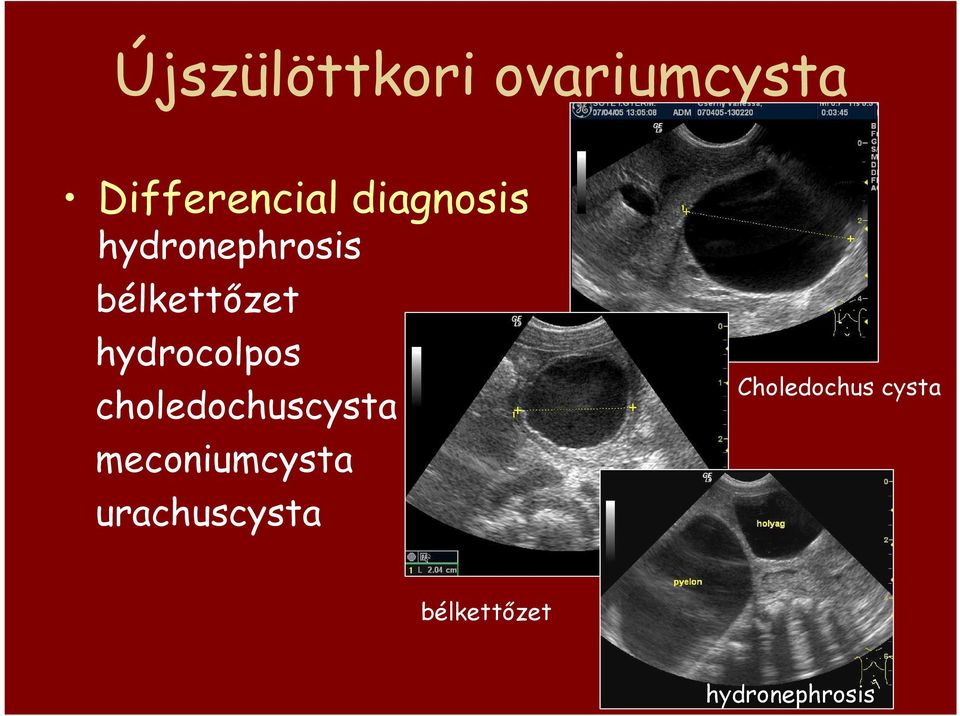 hydrocolpos choledochuscysta meconiumcysta