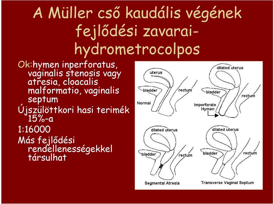 vaginalis septum Újszülöttkori hasi terimék 15%-a 1:16000