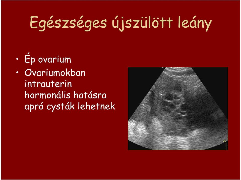 Ovariumokban intrauterin