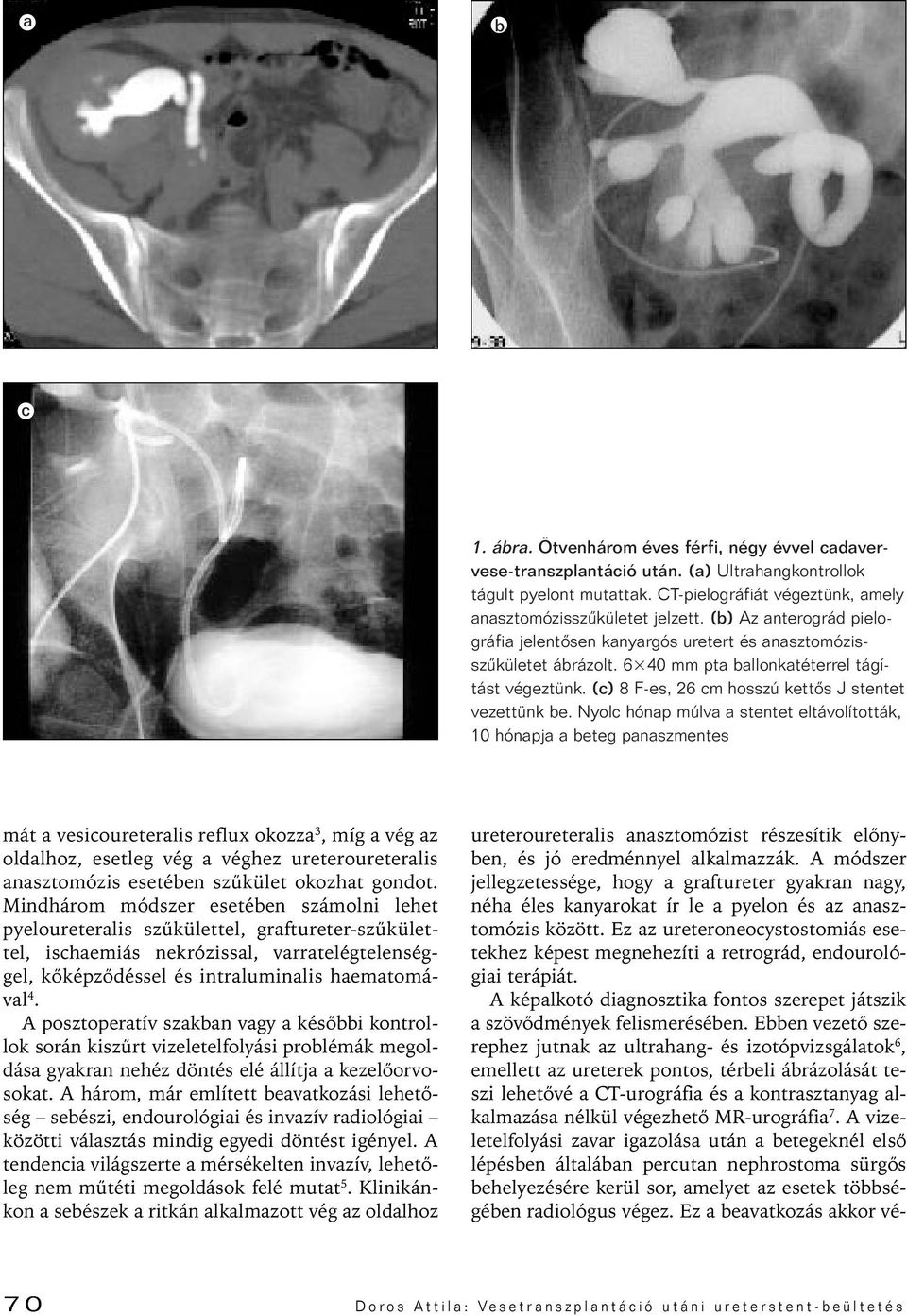 Nyolc hónap múlva a stentet eltávolították, 10 hónapja a beteg panaszmentes mát a vesicoureteralis reflux okozza 3, míg a vég az oldalhoz, esetleg vég a véghez ureteroureteralis anasztomózis esetében