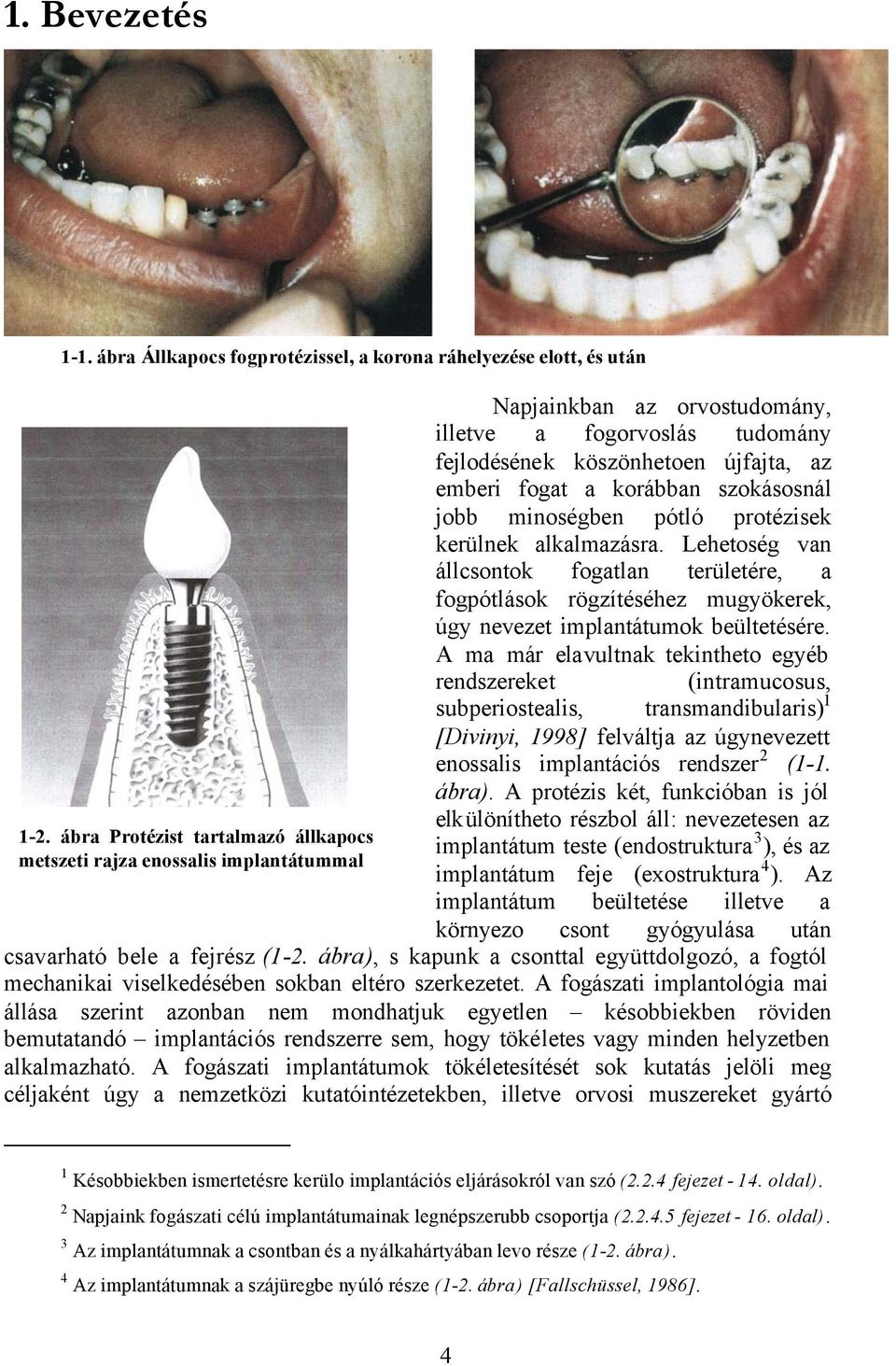 szokásosnál jobb minoségben pótló protézisek kerülnek alkalmazásra. Lehetoség van állcsontok fogatlan területére, a fogpótlások rögzítéséhez mugyökerek, úgy nevezet implantátumok beültetésére.