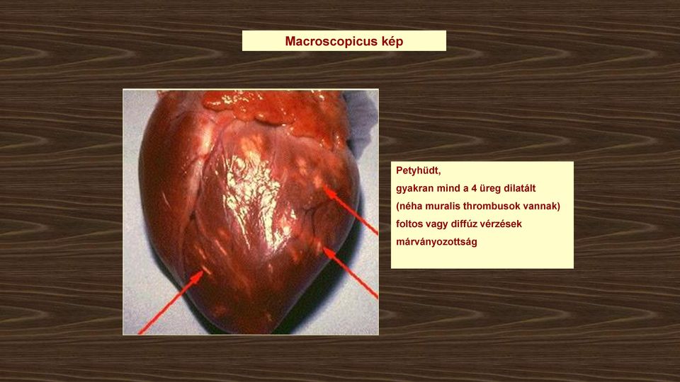 (néha muralis thrombusok vannak)