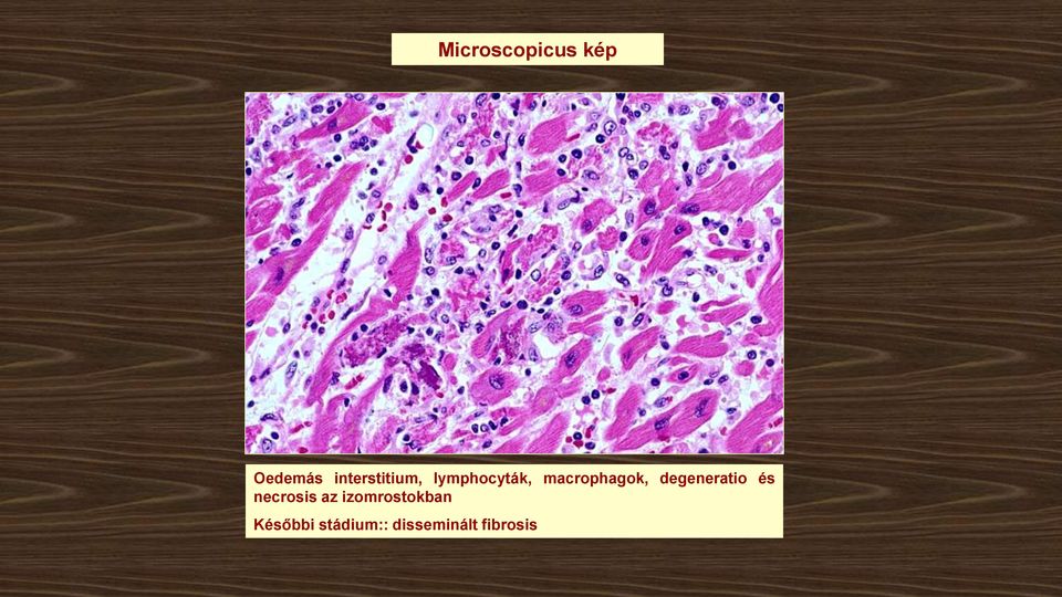 macrophagok, degeneratio és necrosis