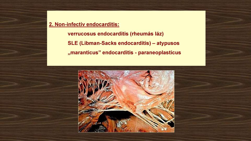 SLE (Libman-Sacks endocarditis)