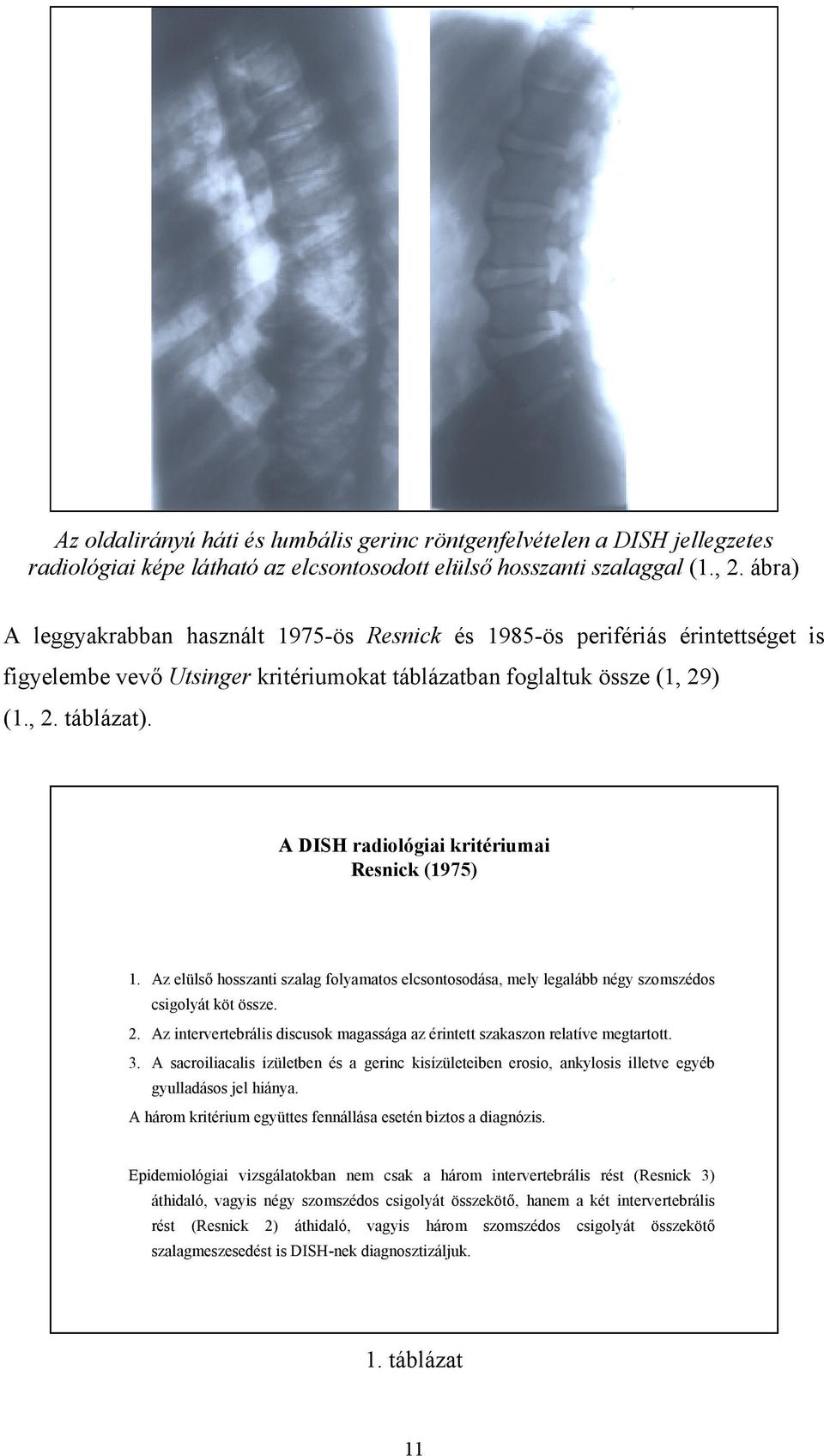 A DISH radiológiai kritériumai Resnick (1975) 1. Az elülső hosszanti szalag folyamatos elcsontosodása, mely legalább négy szomszédos csigolyát köt össze. 2.
