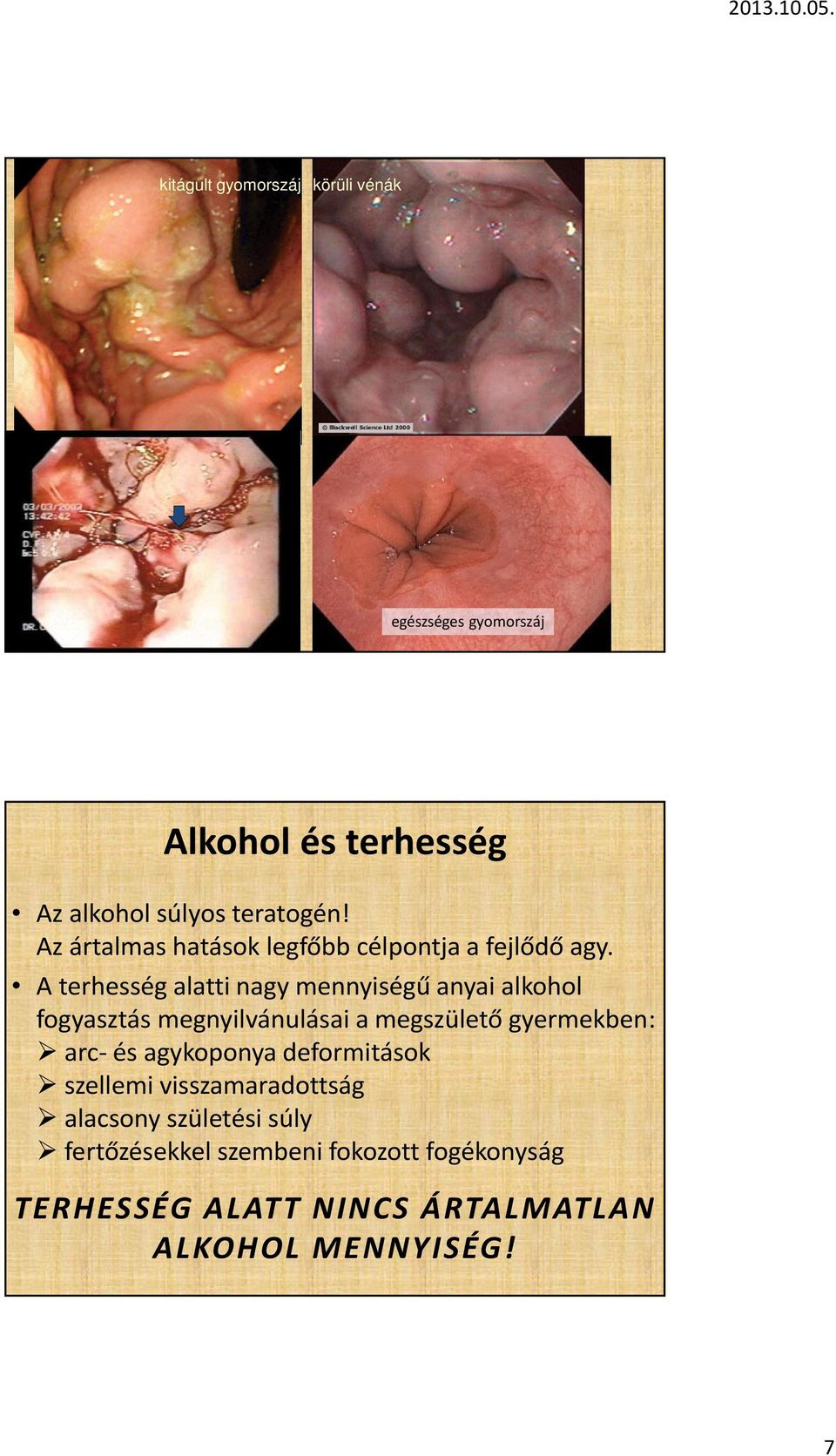 A terhesség alatti nagy mennyiségű anyai alkohol fogyasztás megnyilvánulásai a megszülető gyermekben: arc- és