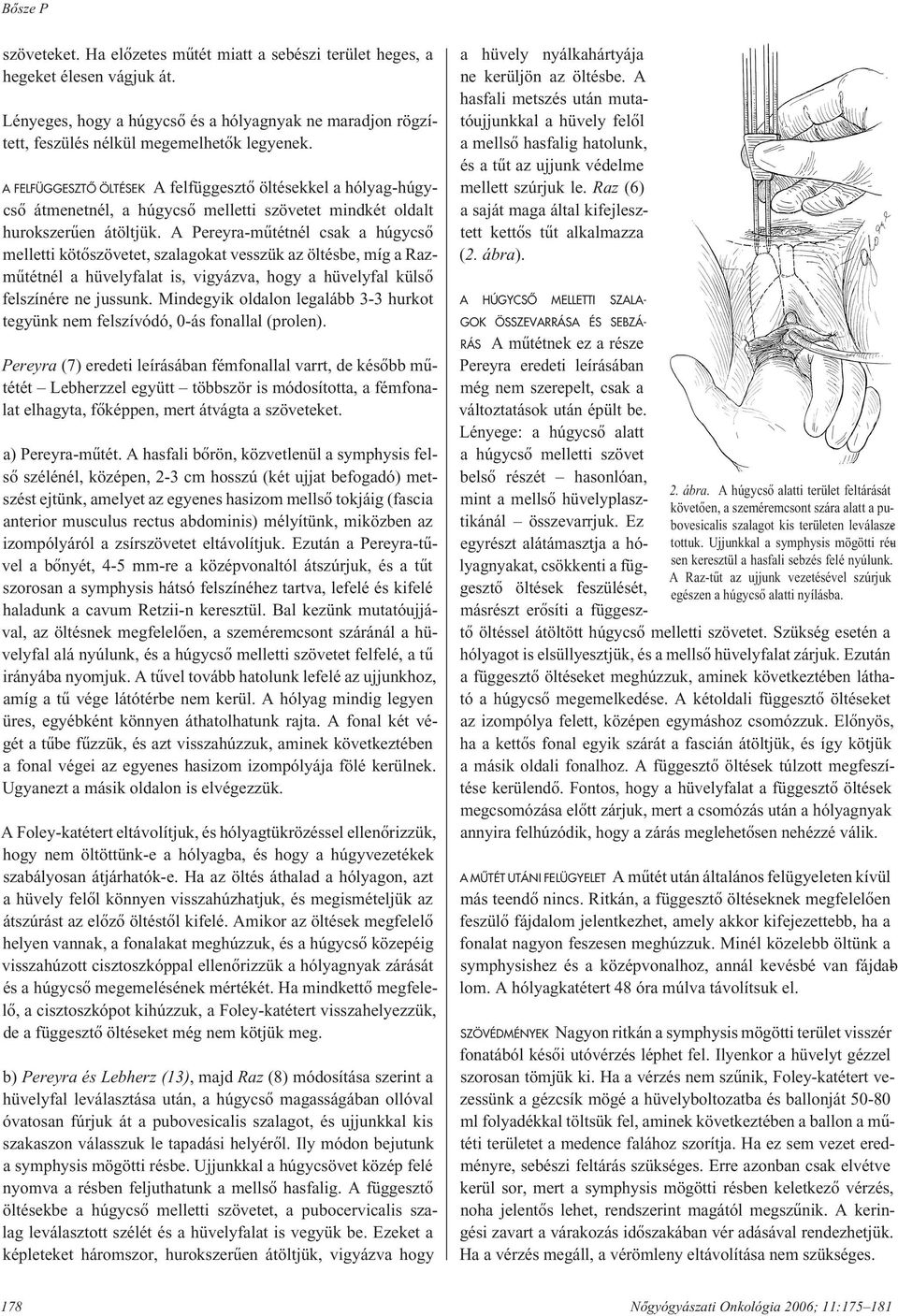 A FELFÜGGESZTÔ ÖLTÉSEK A felfüggesztô öltésekkel a hólyag-húgycsô átmenetnél, a húgycsô melletti szövetet mindkét oldalt hu rok sze rû en átöltjük.