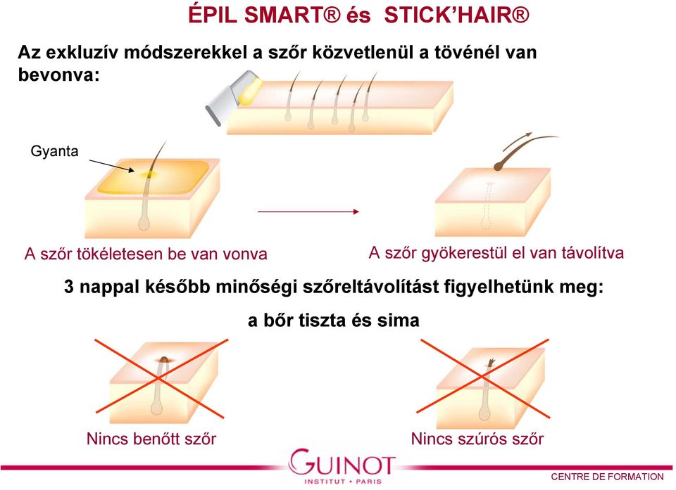 gyökerestül el van távolítva 3 nappal később minőségi szőreltávolítást