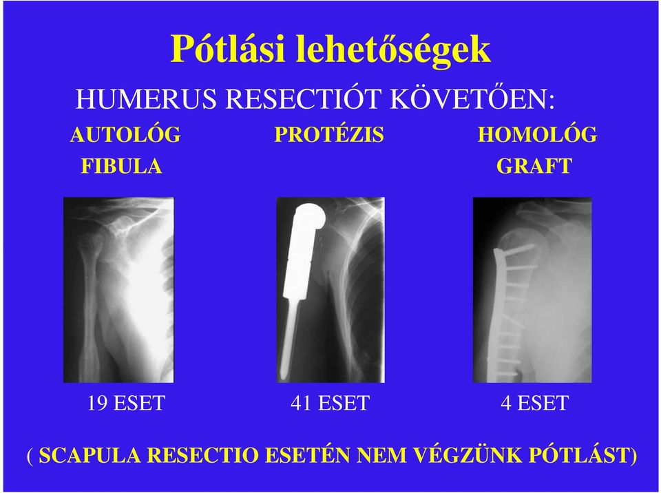 FIBULA GRAFT 19 ESET 41 ESET 4 ESET (