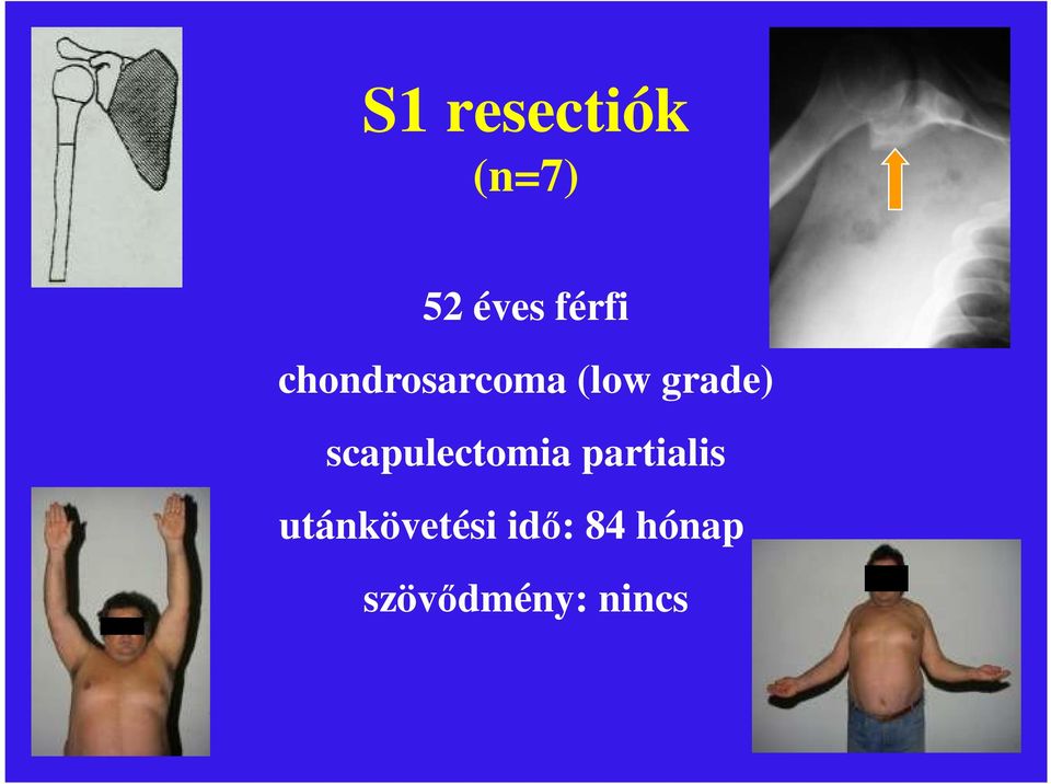 grade) scapulectomia partialis