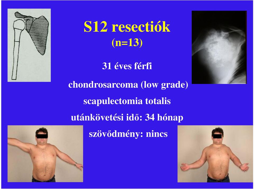 grade) scapulectomia totalis