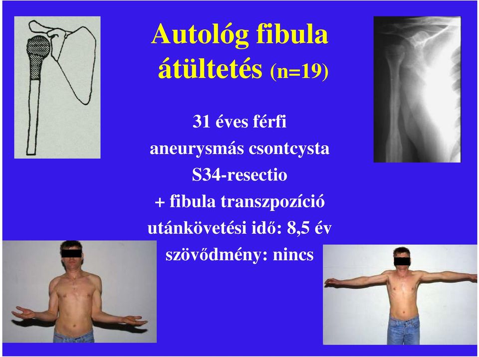 S34-resectio + fibula transzpozíció