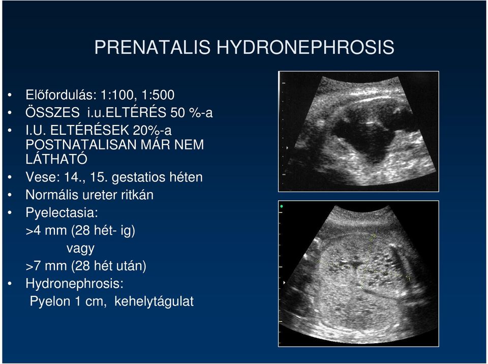 gestatios héten Normális ureter ritkán Pyelectasia: >4 mm (28 hét- ig)