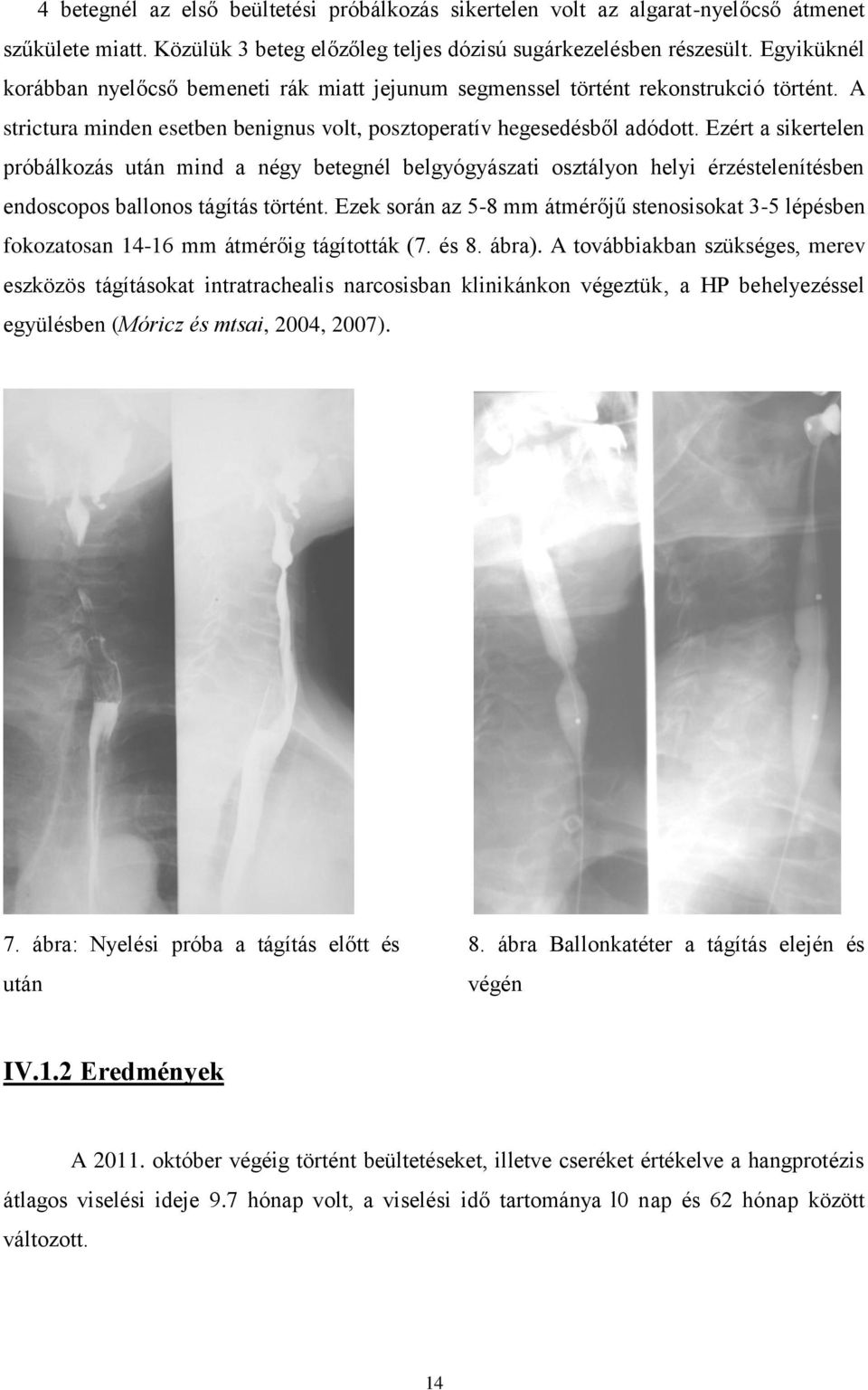 Ezért a sikertelen próbálkozás után mind a négy betegnél belgyógyászati osztályon helyi érzéstelenítésben endoscopos ballonos tágítás történt.