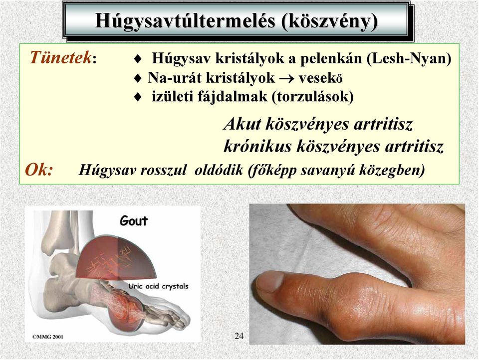 fájdalmak (torzulások) Akut köszvényes artritisz krónikus